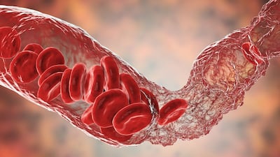 Angiodynamics Initiates Thrombectomy Trial In Europe After Showing Positive Trial Results in US